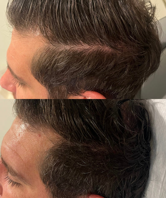 PRF Hair Restoration